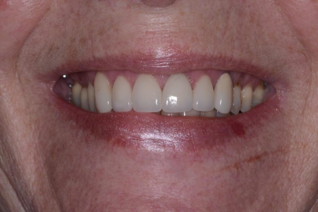 The patient's teeth aligned and cosmetically improved appearance after crowns.