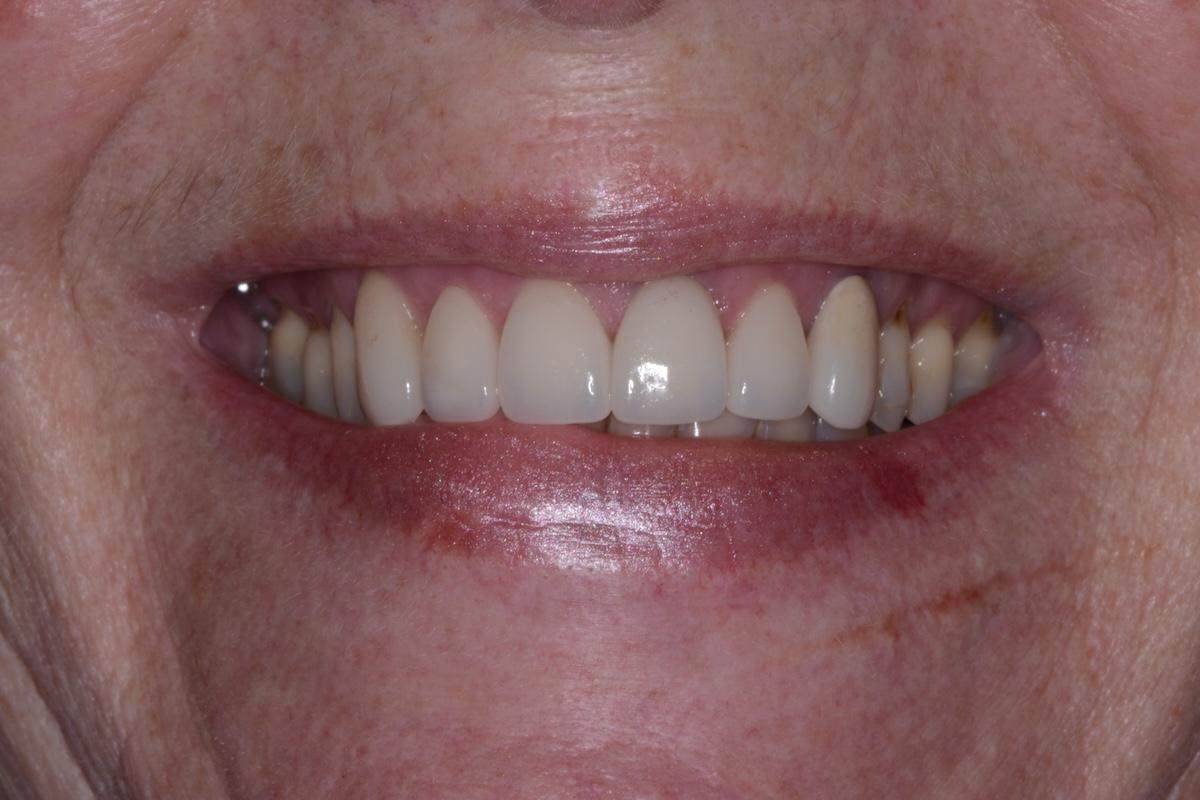 The patient's teeth aligned and cosmetically improved appearance after crowns.