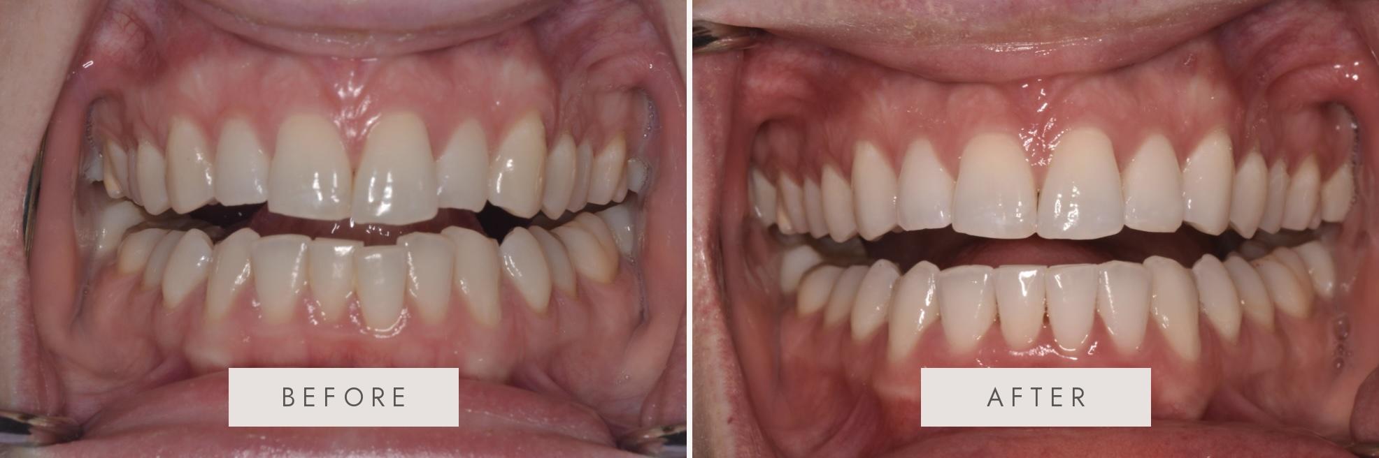 A before and after image of a patient at Cooper Dental in downtown Calgary who received Invisalign and dental bonding treatment.