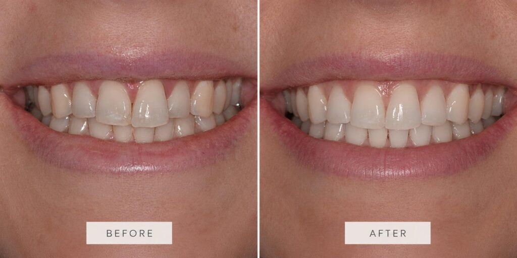 A before and after of a patient at Cooper Dental in downtown Calgary.