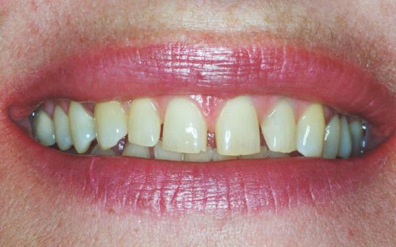 A before image of a patient at Cooper Dental who was treated with veneers for excess space.