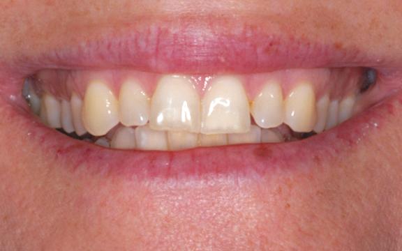 A before image of a patient at Cooper Dental who was treated with veneers for tooth wear.