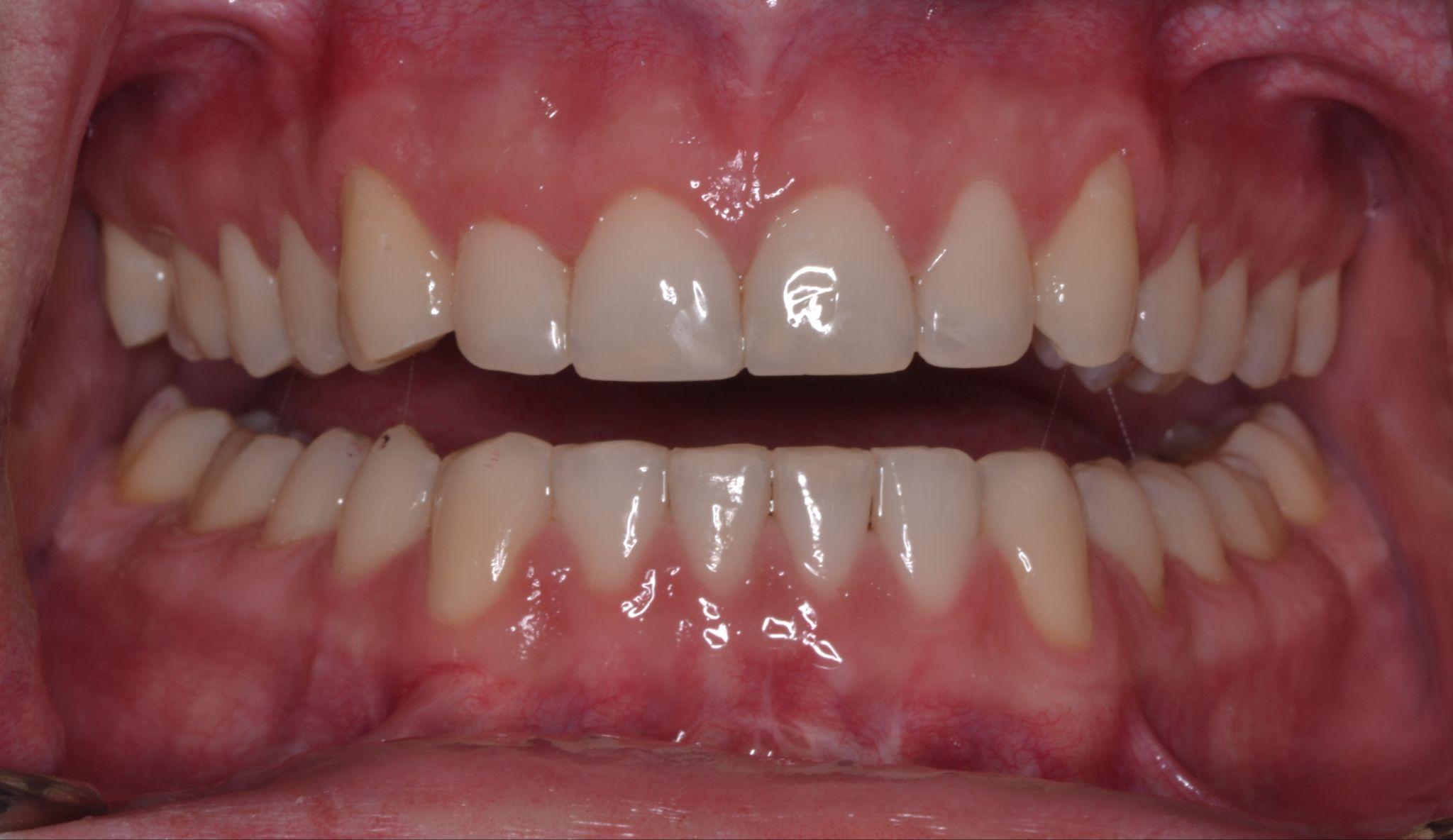A patient from Cooper Dental in downtown Calgary after dental bonding treatment.