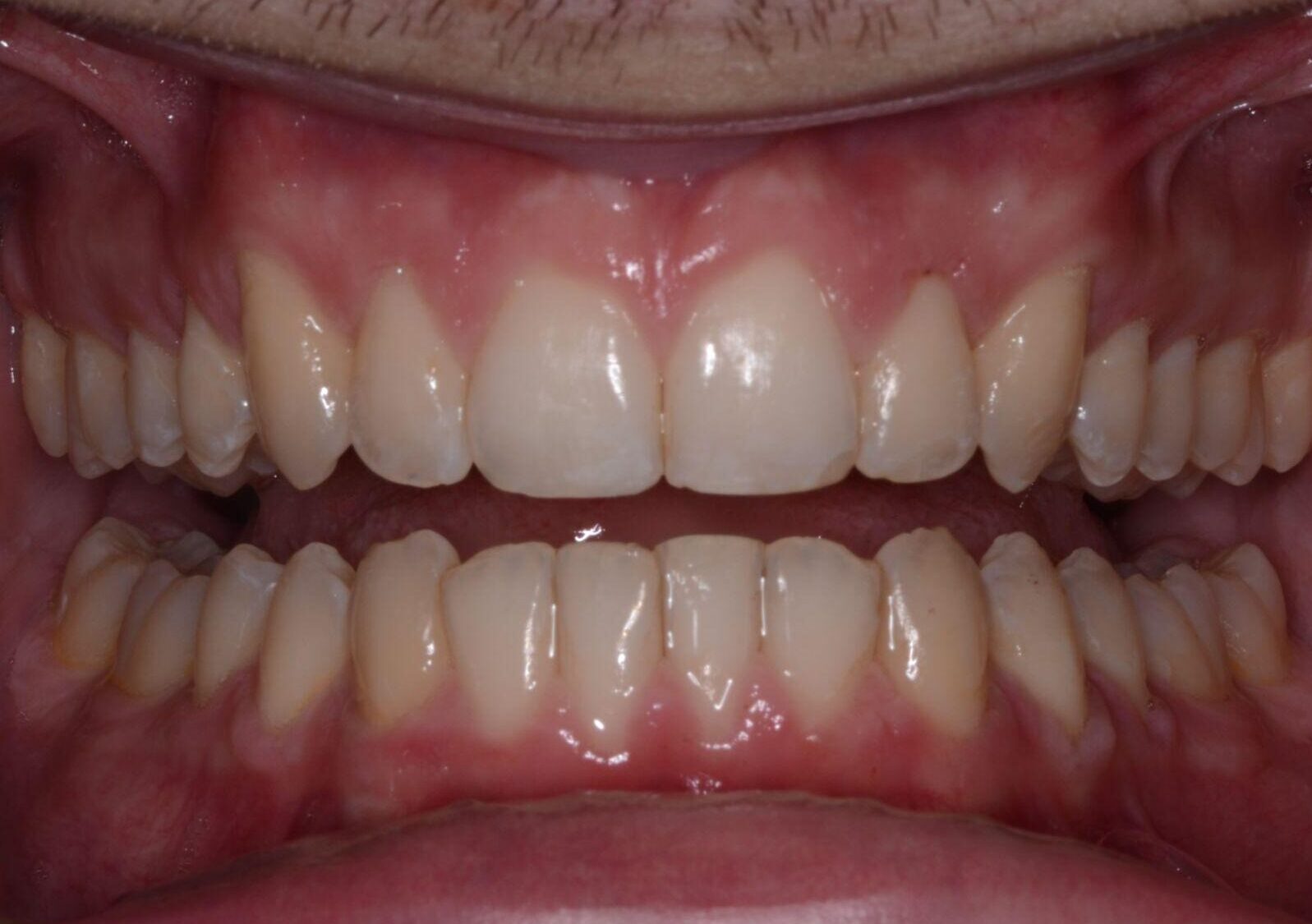 A patient from Cooper Dental in downtown Calgary after Invisalign treatment.