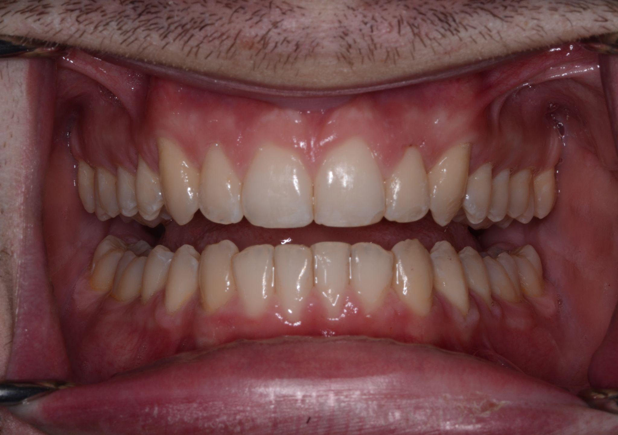 A patient from Cooper Dental in downtown Calgary after Invisalign treatment.