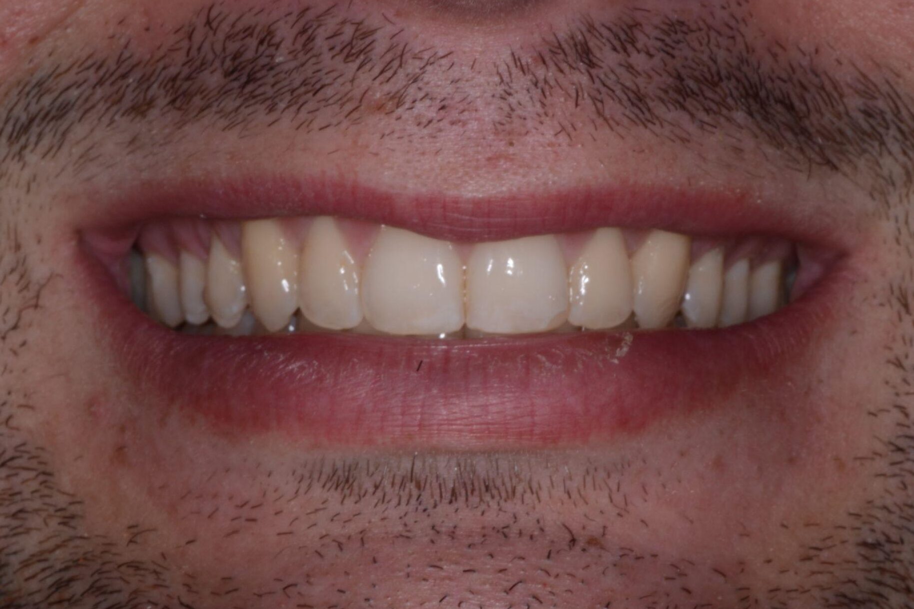 A patient from Cooper Dental in downtown Calgary after Invisalign treatment.
