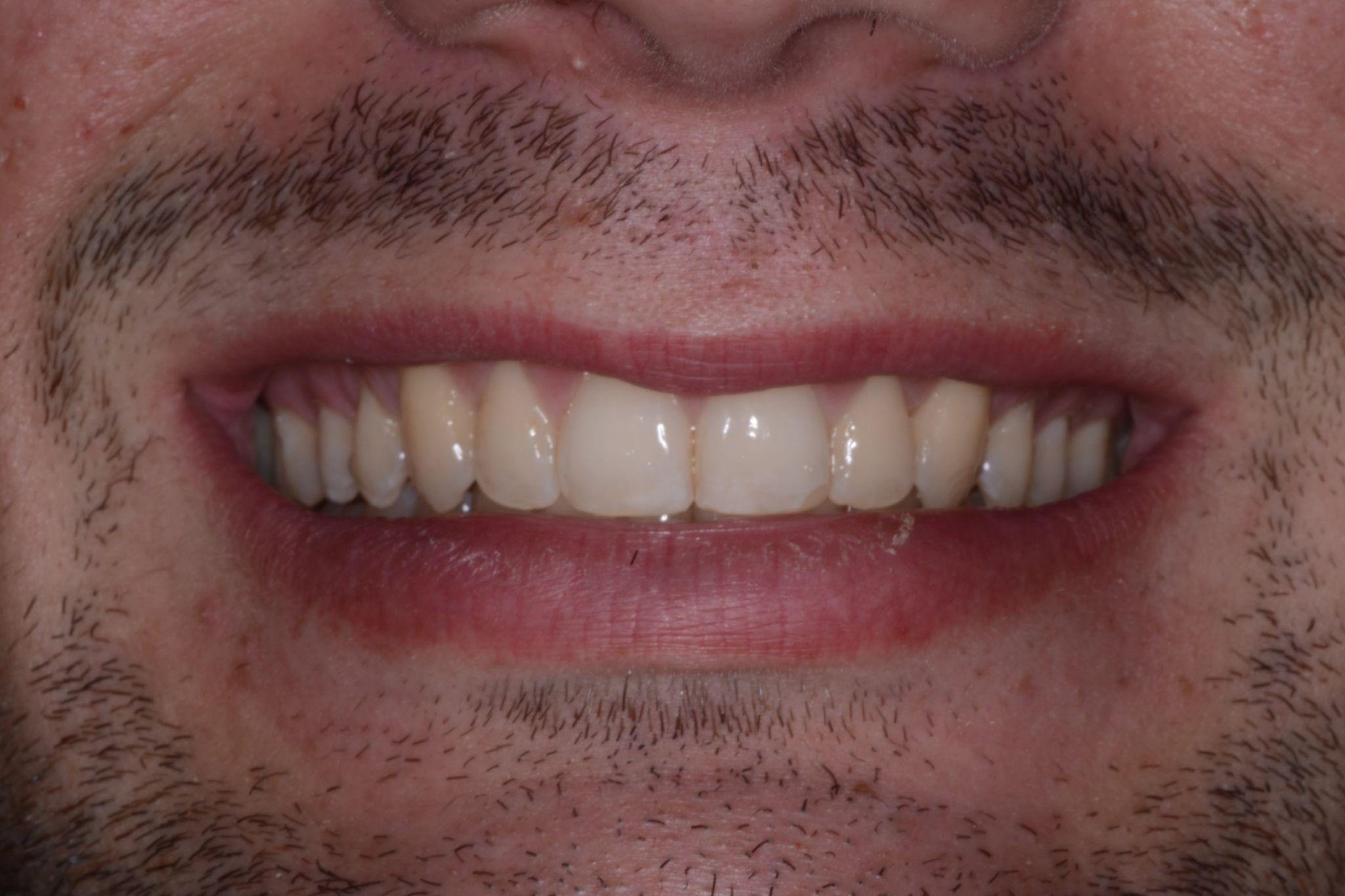 A patient from Cooper Dental in downtown Calgary after Invisalign treatment.