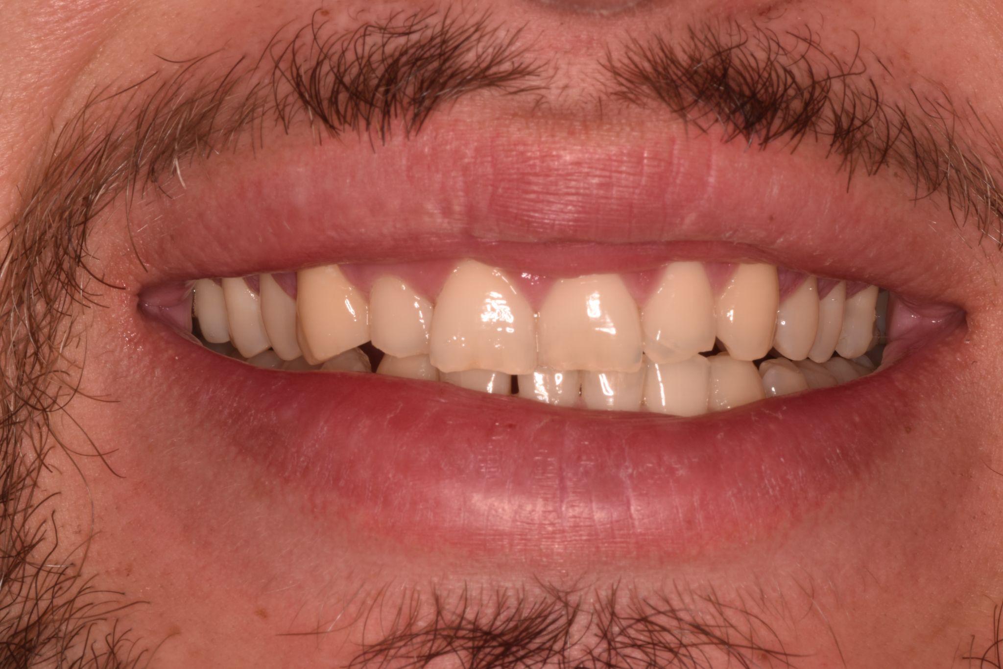 A patient from Cooper Dental in downtown Calgary before dental bonding treatment.