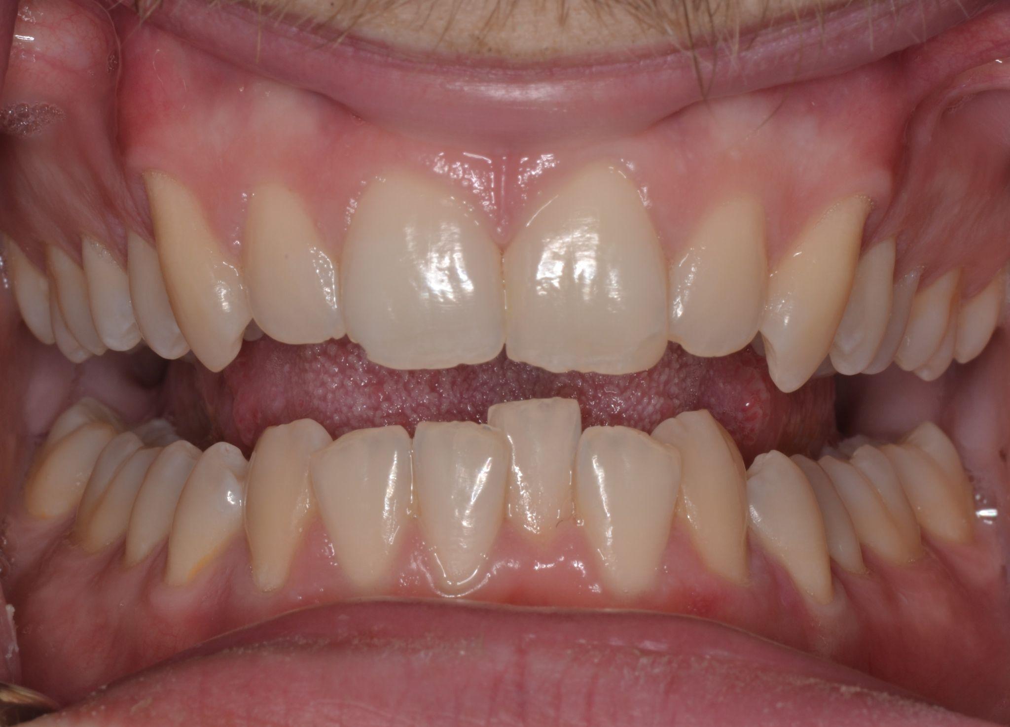 A patient from Cooper Dental in downtown Calgary before Invisalign treatment.