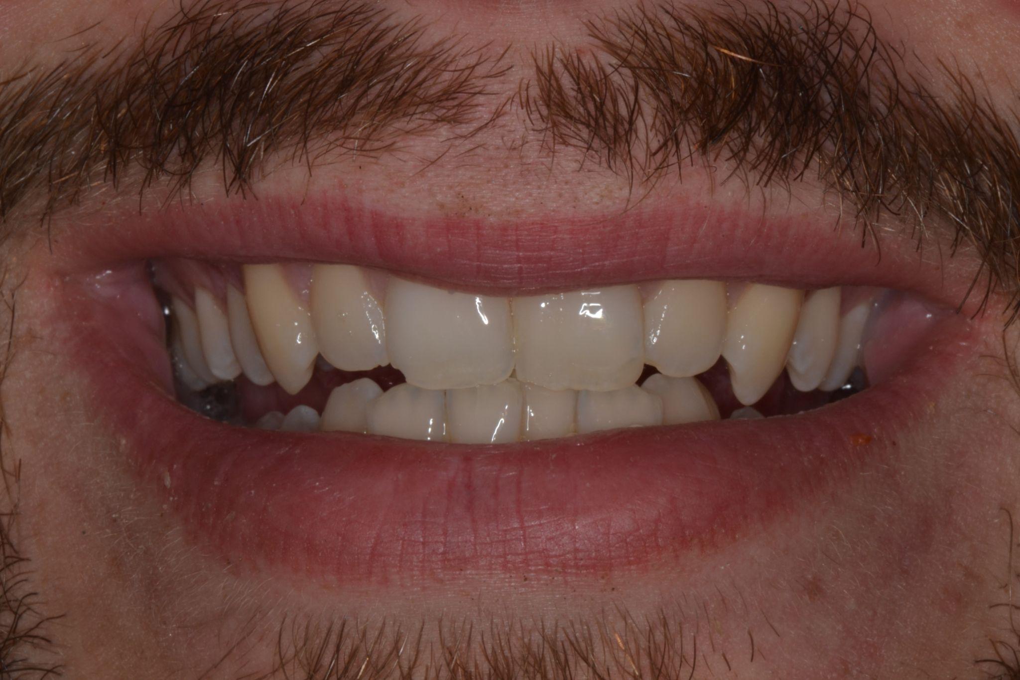 A patient from Cooper Dental in downtown Calgary before Invisalign treatment.