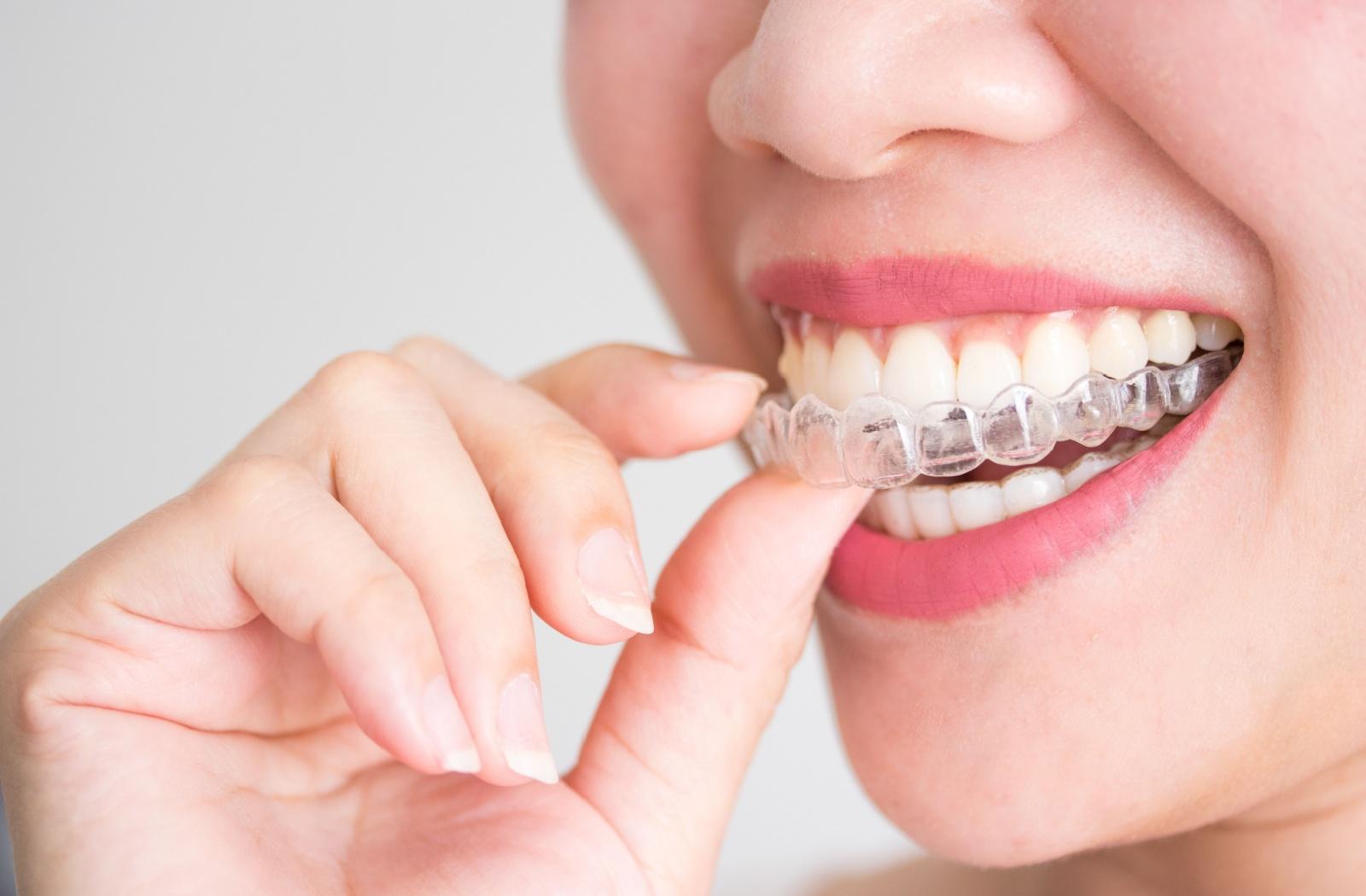 A person inserting Invisalign clear aligners in their mouth.