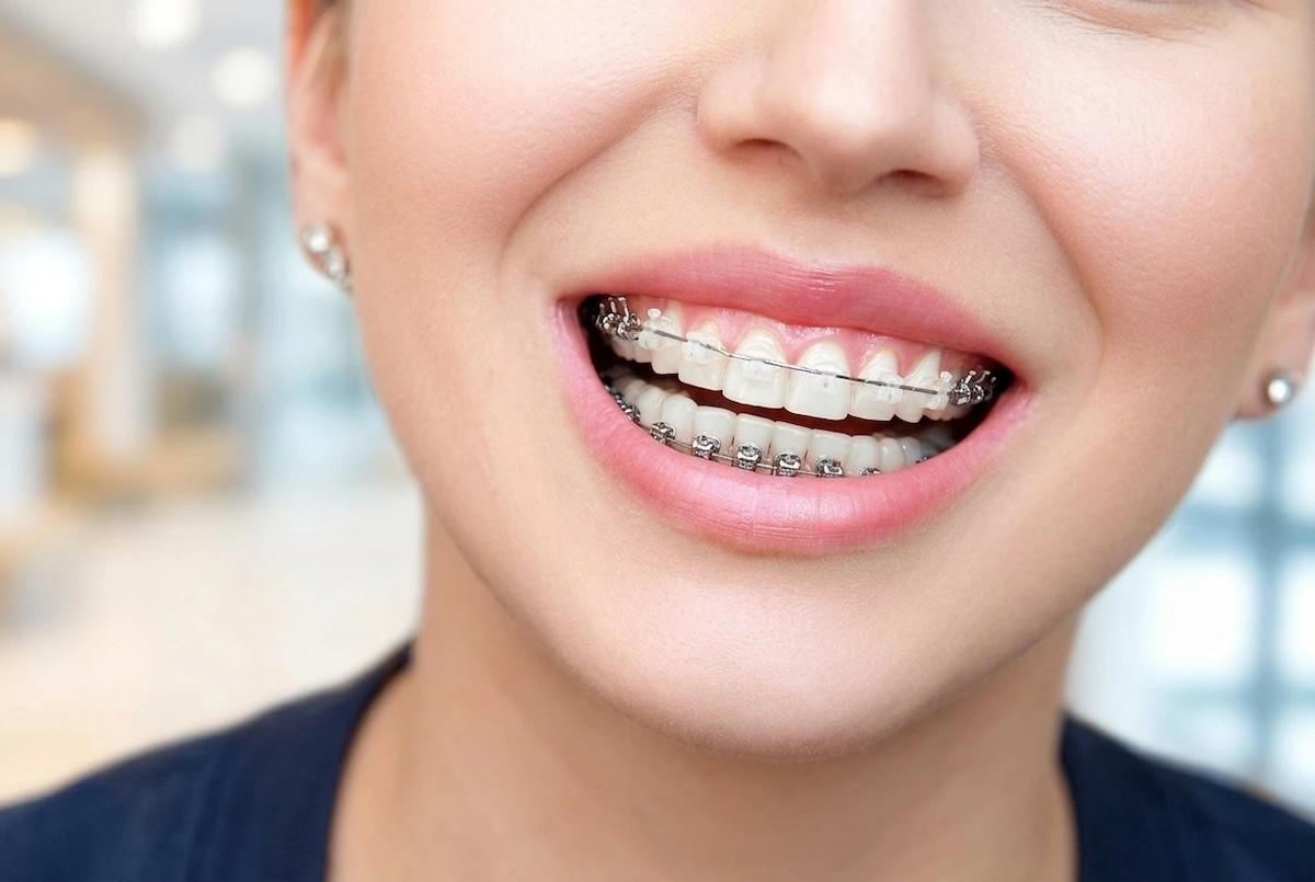 A person smiling, showing their fixed braces with ceramic brackets on their front teeth and metal brackets on the rest of their teeth.
