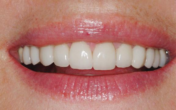 An after image of a patient at Cooper Dental who was treated with veneers for excess space.