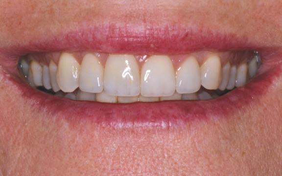 An after image of a patient at Cooper Dental who was treated with veneers for tooth wear.